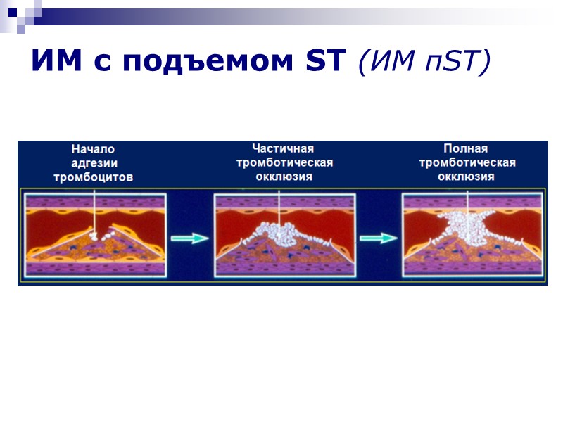 ИМ с подъемом ST (ИМ пST)